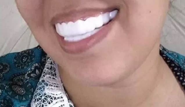 VÍDEO! “Dentes da Shopee” representam alto risco a saúde