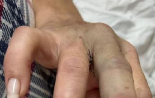 Enteado ataca mulher, que perde dedo e precisa de 300 pontos na cabeça